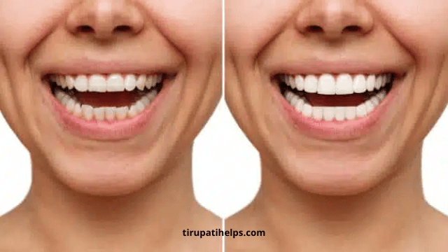 Breaking Down the Differences: Pros and Cons of Porcelain vs Composite Veneers